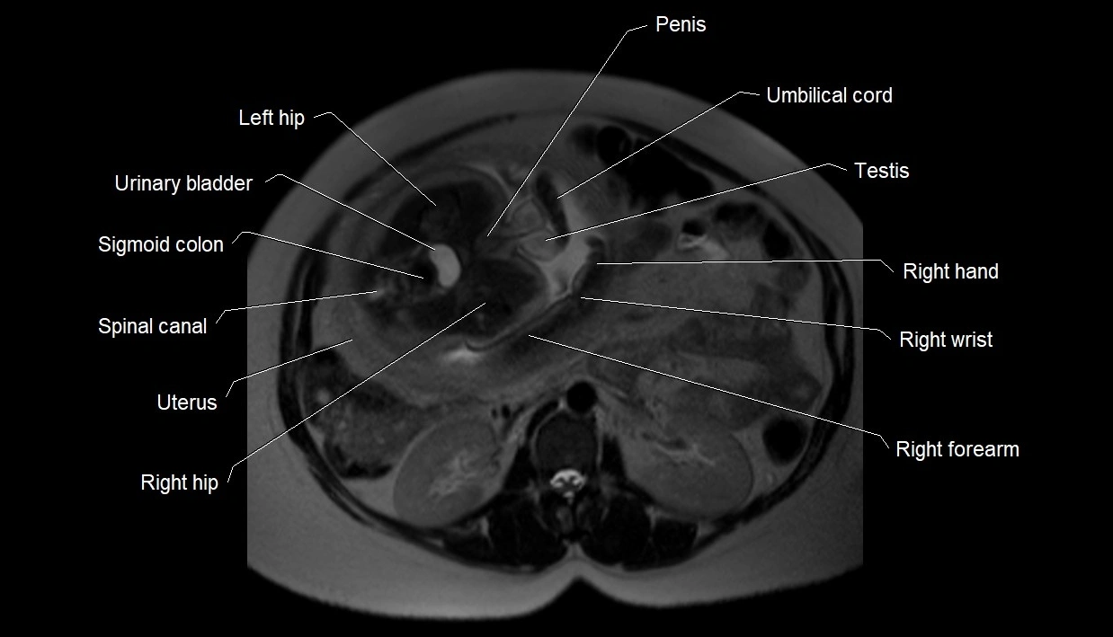 MRI fetal anatomy axial image 5.webp